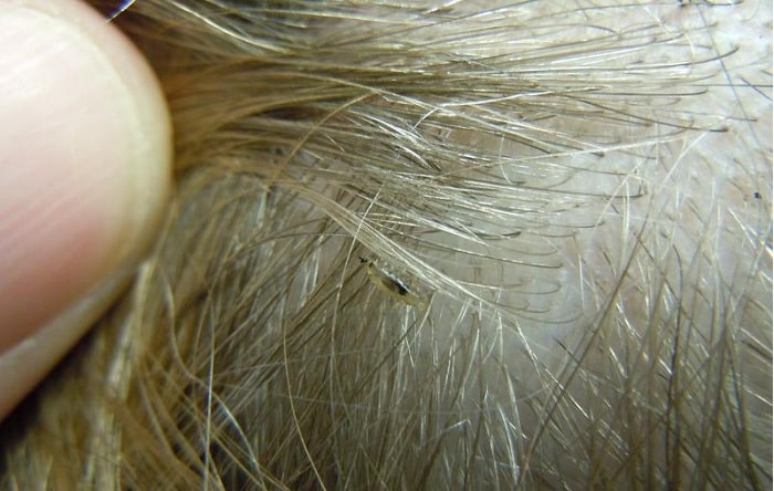 can you catch headlice from mattress stores