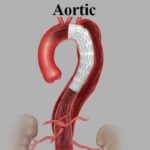 Aortic