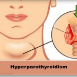 Hyperparathyroidism