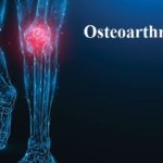 Osteoarthritis
