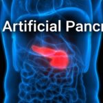 artificial-pancreas