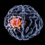 brain cancer