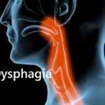 dysphagia