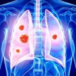 lung-cancer