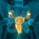 Advanced-Ovarian-Cancer