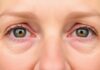 Under Eye Wrinkle