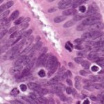 Bevacizumab-to-be-Used-by-NHS