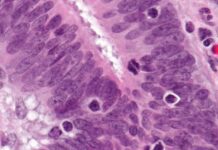 Bevacizumab to be Used by NHS for Colorectal Cancer Bevacizumab to be Used by NHS