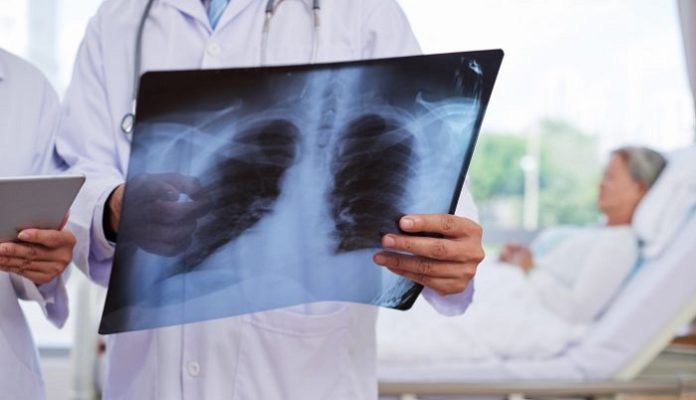 Untreatable Lung Cancer Patients Get Breakthrough Treatment