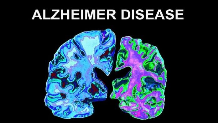 Trends of Genuv Cancer Drug Show Potential For Alzheimers