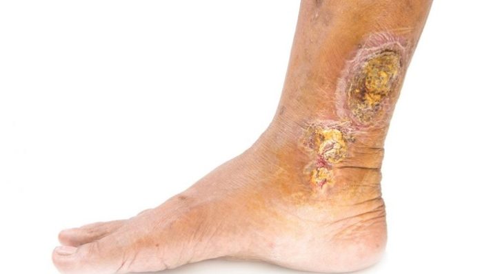 Leg Ulcers: How Do They Form And How To Treat Them
